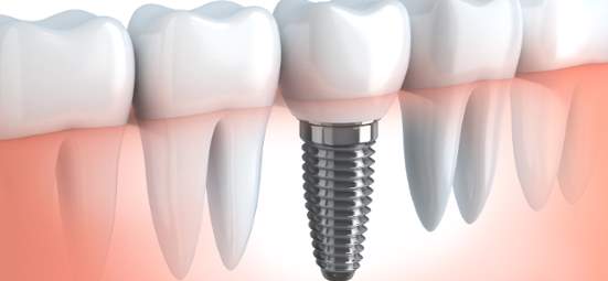 implantes dentales en el centro de madrid