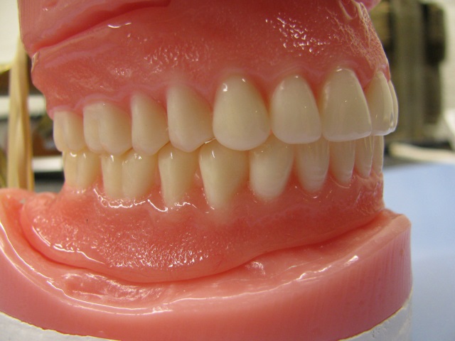 implantes dentales baratos en Madrid