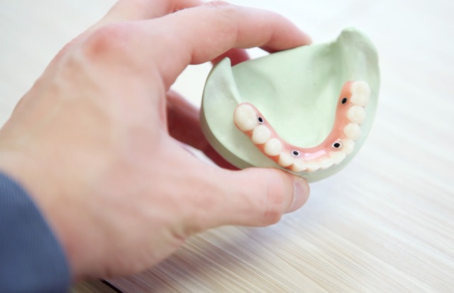 implantes dentales baratos en Madrid